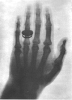 X-ray image of a hand
