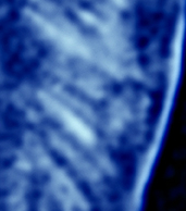 X-ray Stripes in Tycho's SNR