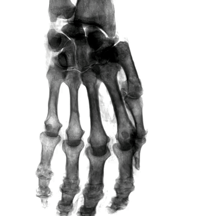 Bone scan performed by prototype stationary CT scan system